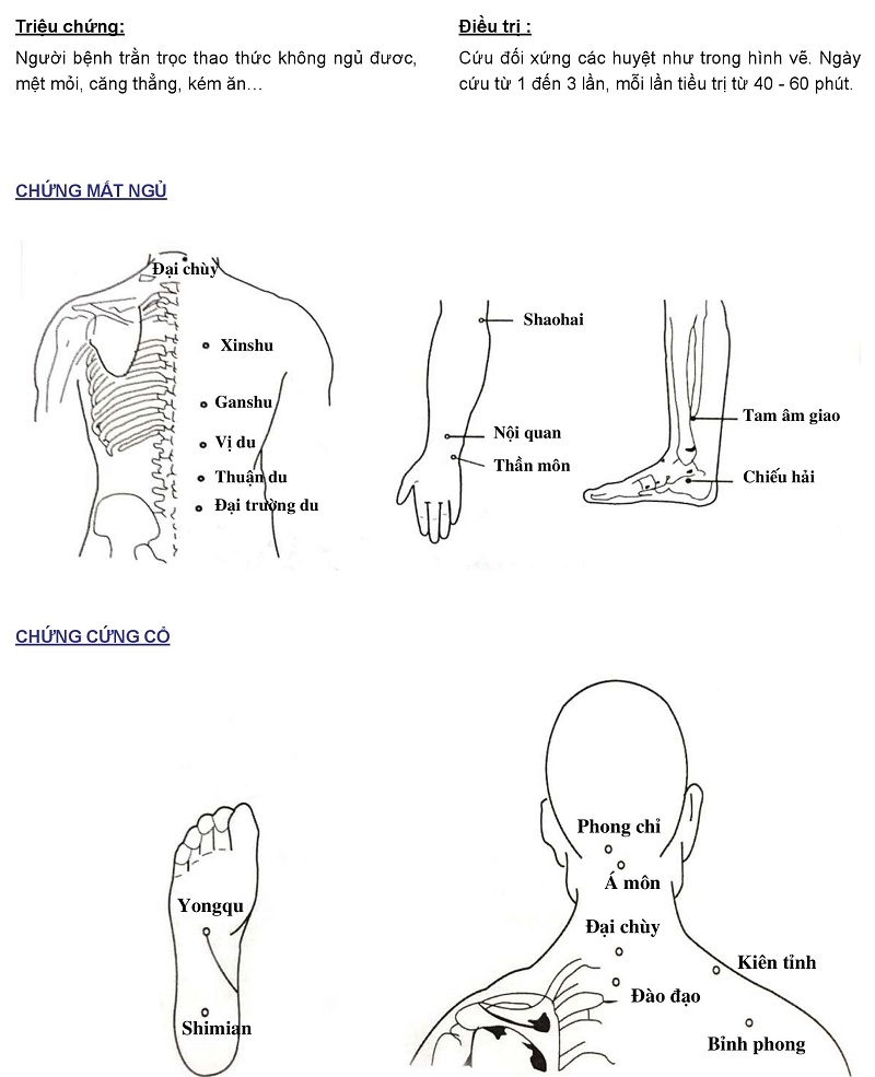 Cứu ngải chữa chứng mất ngủ, đau cứng cổ