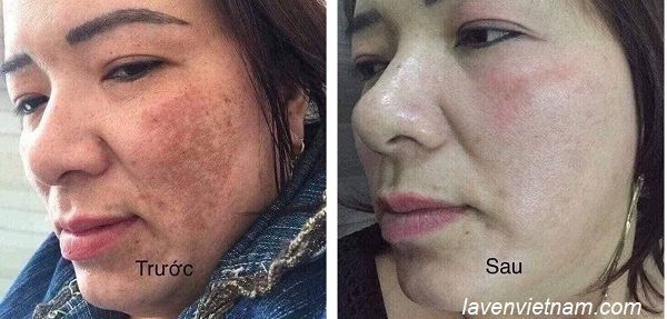 Hình ảnh trước và sau khi sử dụng 2 hộp Olimpiq hỗ trợ tăng sinh tế bào gốc nội sinh
