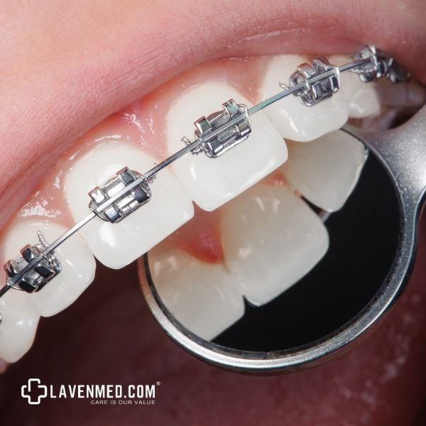 Với niềng răng, bạn cần đánh răng kỹ hơn để đảm bảo rằng các mảng bám không bị mắc kẹt trong mắc cài và dây niềng