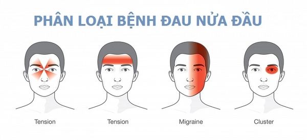 Phân loại bệnh đau nửa đầu