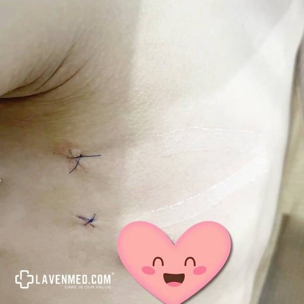 Vết mổ nội soi sau phẫu thuật cắt hạch giao cảm trong điều trị mồ hôi