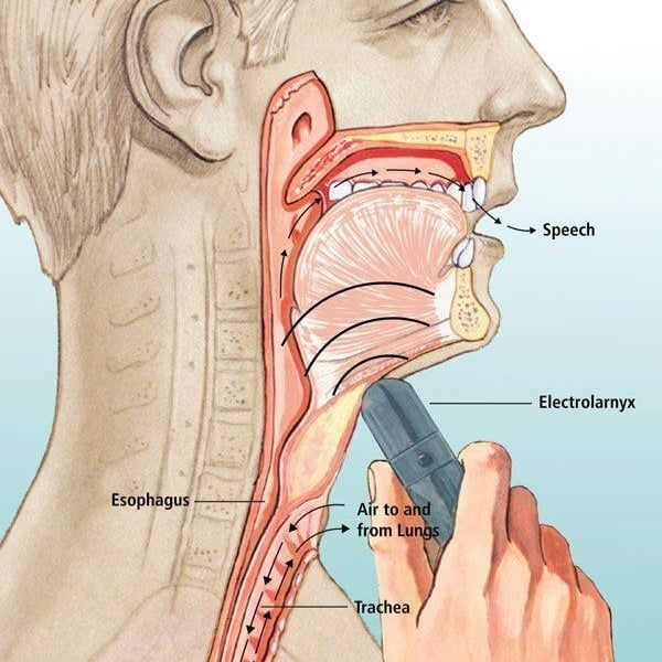 Thanh quản điện tử là lựa chọn tuyệt vời nếu bạn: Không thể sử dụng giọng nói giả vì lý do y tế.