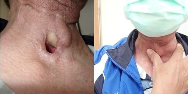 Một người đàn ông 60 tuổi đã cắt bỏ toàn bộ thanh quản do ung thư thanh quản có một lỗ mở khí quản ở cổ