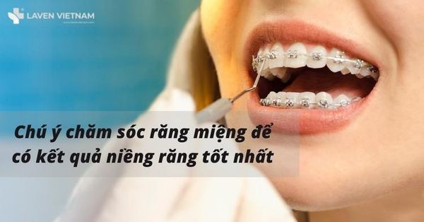 Chăm sóc răng miệng để có kết quả niềng răng thành công