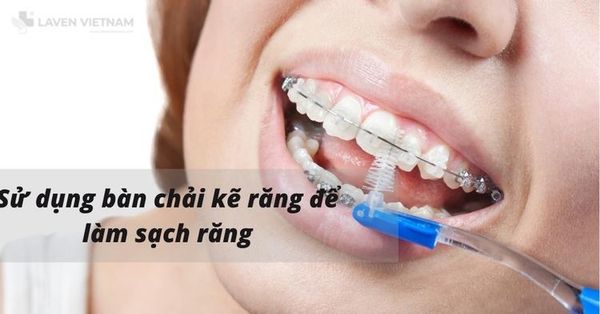 Sử dụng bàn chải kẽ để làm sạch răng