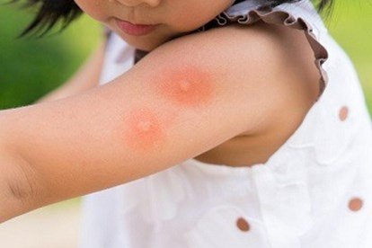 8 cách đuổi muỗi hiệu quả bảo vệ gia đình