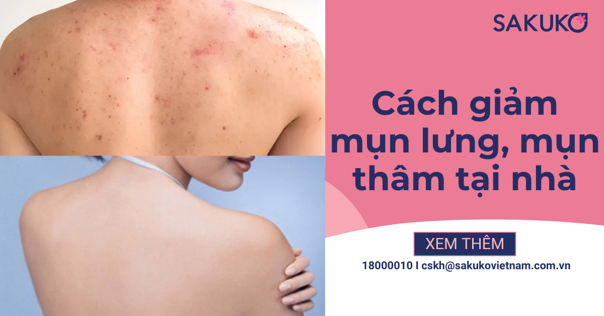 Nguyên nhân và bí kíp giảm mụn lưng và thâm mụn hiệu quả tại nhà