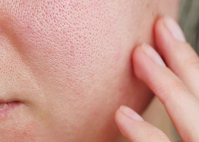 Làn da dầu mụn lỗ chân lông to