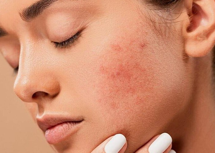 Dấu hiệu bắt đầu dị ứng