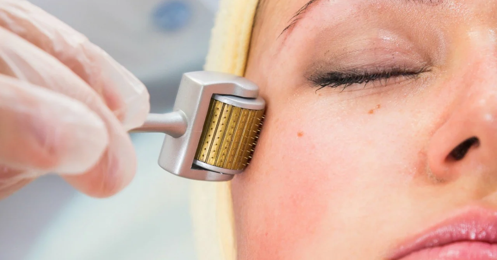 Kích thích sản sinh collagen bằng phương pháp lăn kim