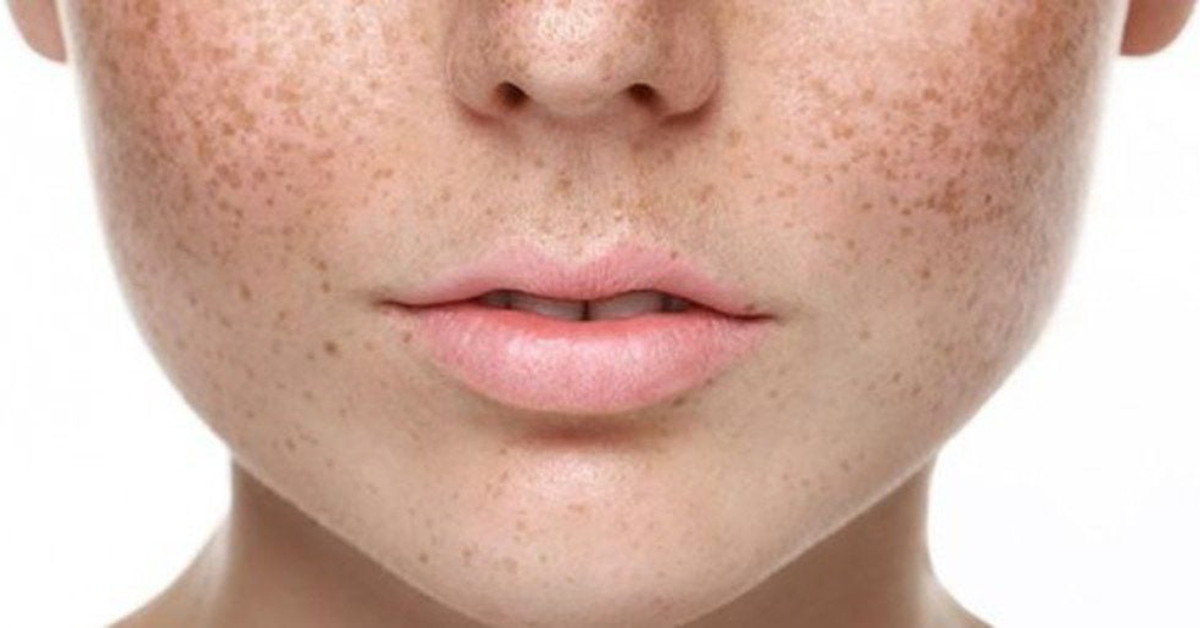 Nguy cơ sạm da tăng cao với mẹ bầu khi không sử dụng kem chống nắng