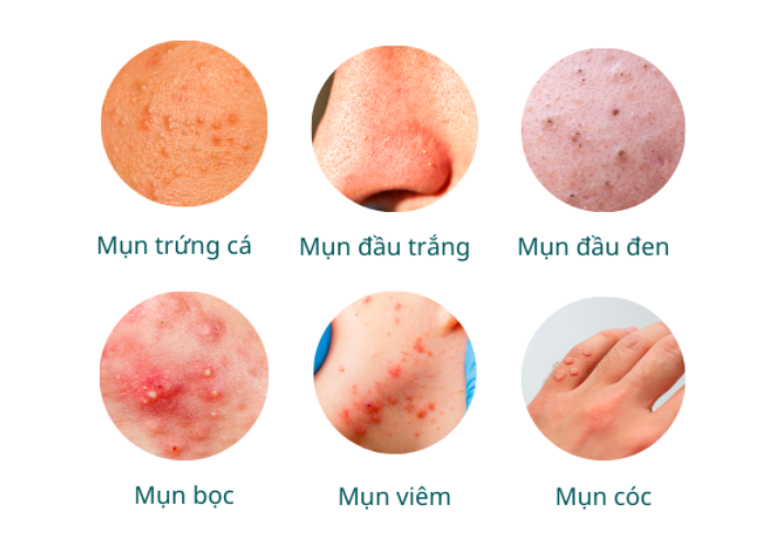Các vấn đề về mụn