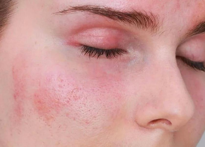 Tình trạng viêm da tiếp xúc