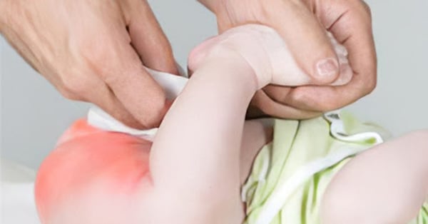 Bé bị hăm tã khi đóng bỉm