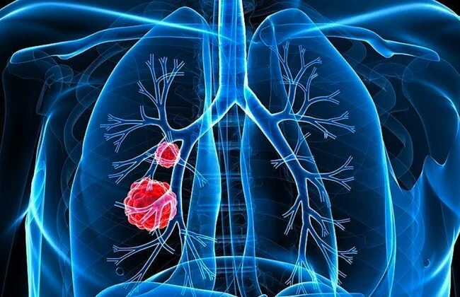 Triệu chứng ung thư phổi giai đoạn đầu mà bạn không nên bỏ qua