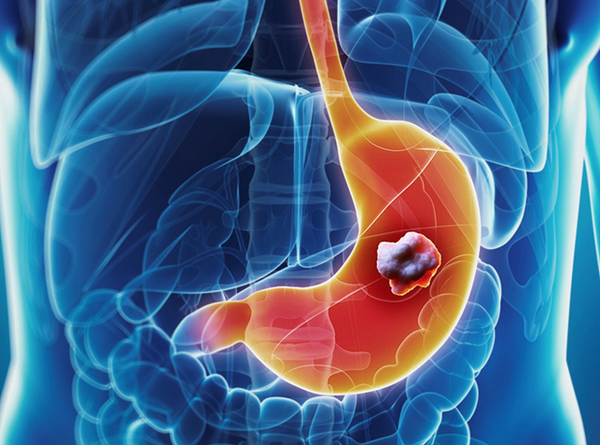 Phương pháp điều trị ung thư dạ dày được áp dụng hiện nay