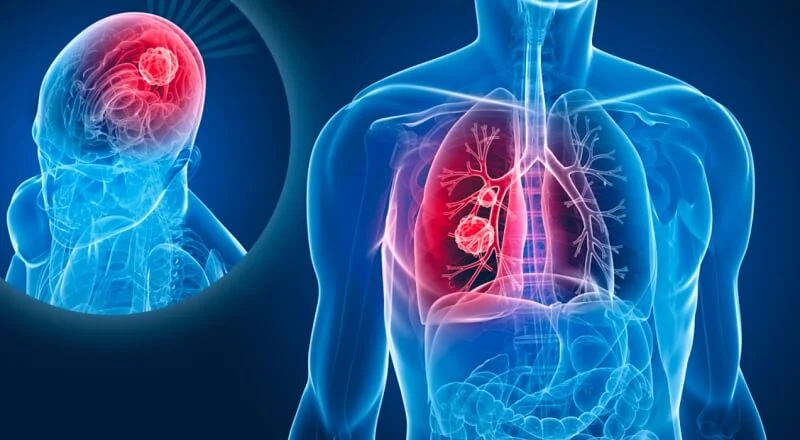 Ung thư phổi di căn não là gì?