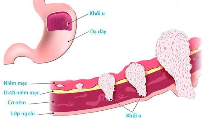 Chi phí điều trị ung thư dạ dày: Yếu tố ảnh hưởng và cách tiết kiệm