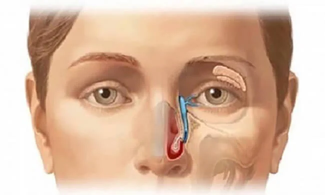 Ung thư mũi và 1001 điều cần biết