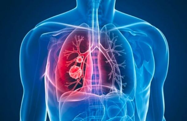 Ung thư phổi giai đoạn 3 là gì?