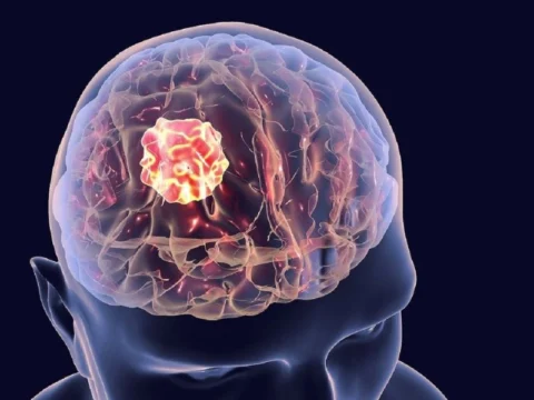 Ung thư não: Nguyên nhân, dấu hiệu và cách điều trị