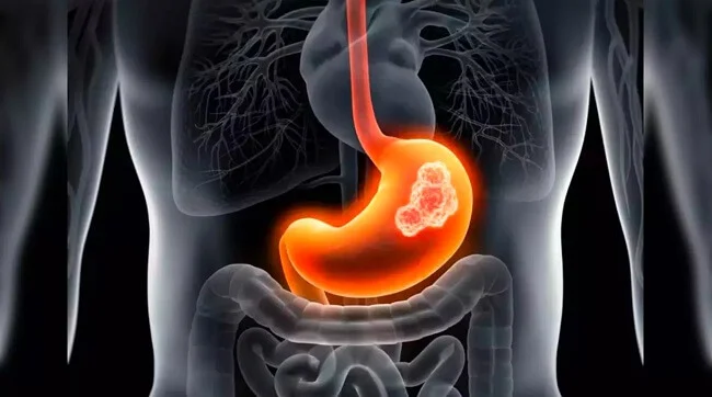 Ung thư dạ dày giai đoạn đầu – Nhận biết sớm, điều trị hiệu quả