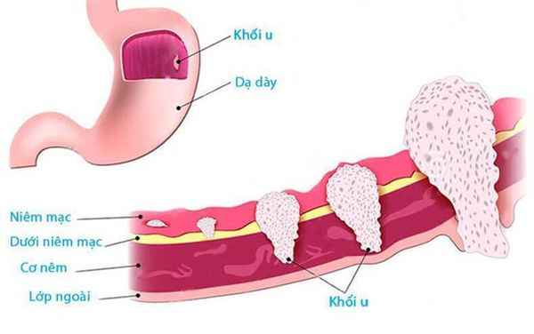 Ung thư dạ dày di căn: Triệu chứng, chẩn đoán và điều trị
