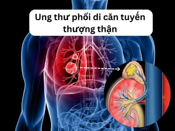 Ung thư phổi di căn tuyến thượng thận là gì?