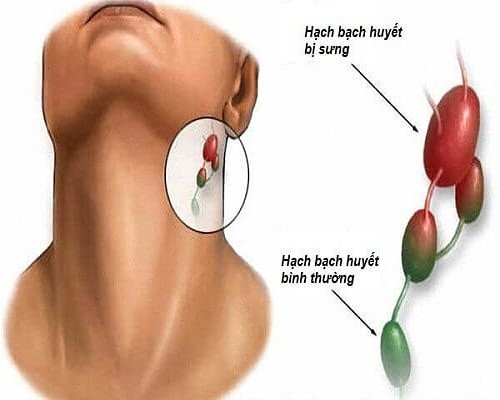 Ung thư phổi di căn hạch là gì?