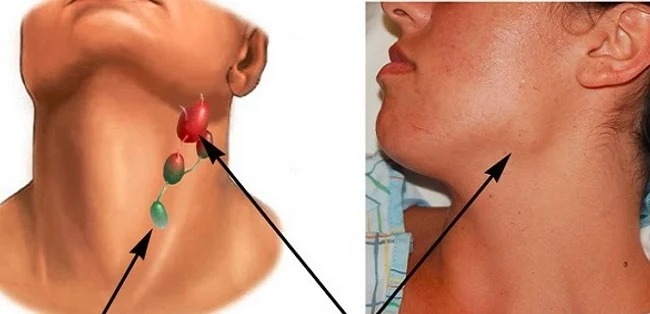 Đừng bỏ qua những thông tin sau nếu bạn muốn hiểu về ung thư hạch