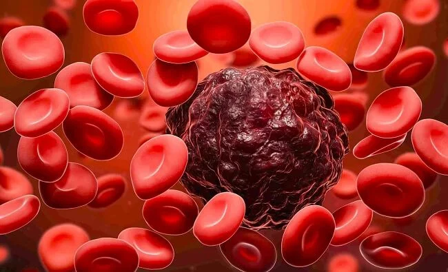 Ung thư máu sống được bao lâu? Làm sao để thời gian dài thật dài?