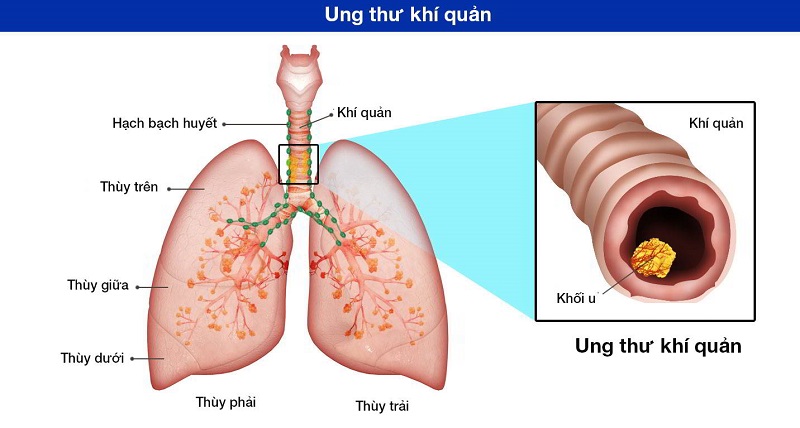 Ung thư khí quản là gì?