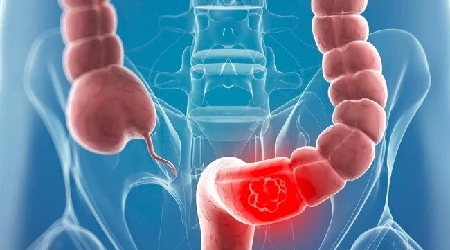 Tổng hợp thông tin cần biết về ung thư ruột