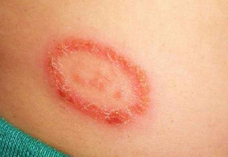 Tìm hiểu chung chàm đồng tiền