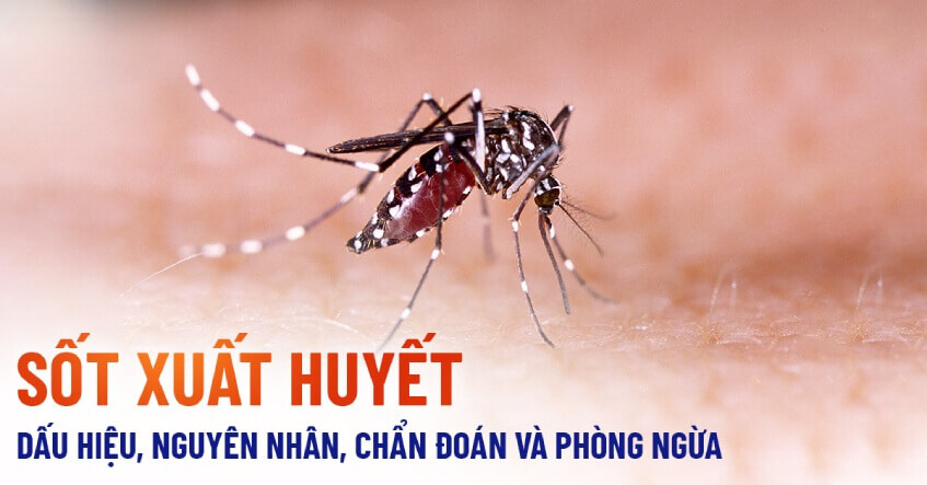 Chẩn đoán sốt xuất huyết Dengue và điều trị bệnh
