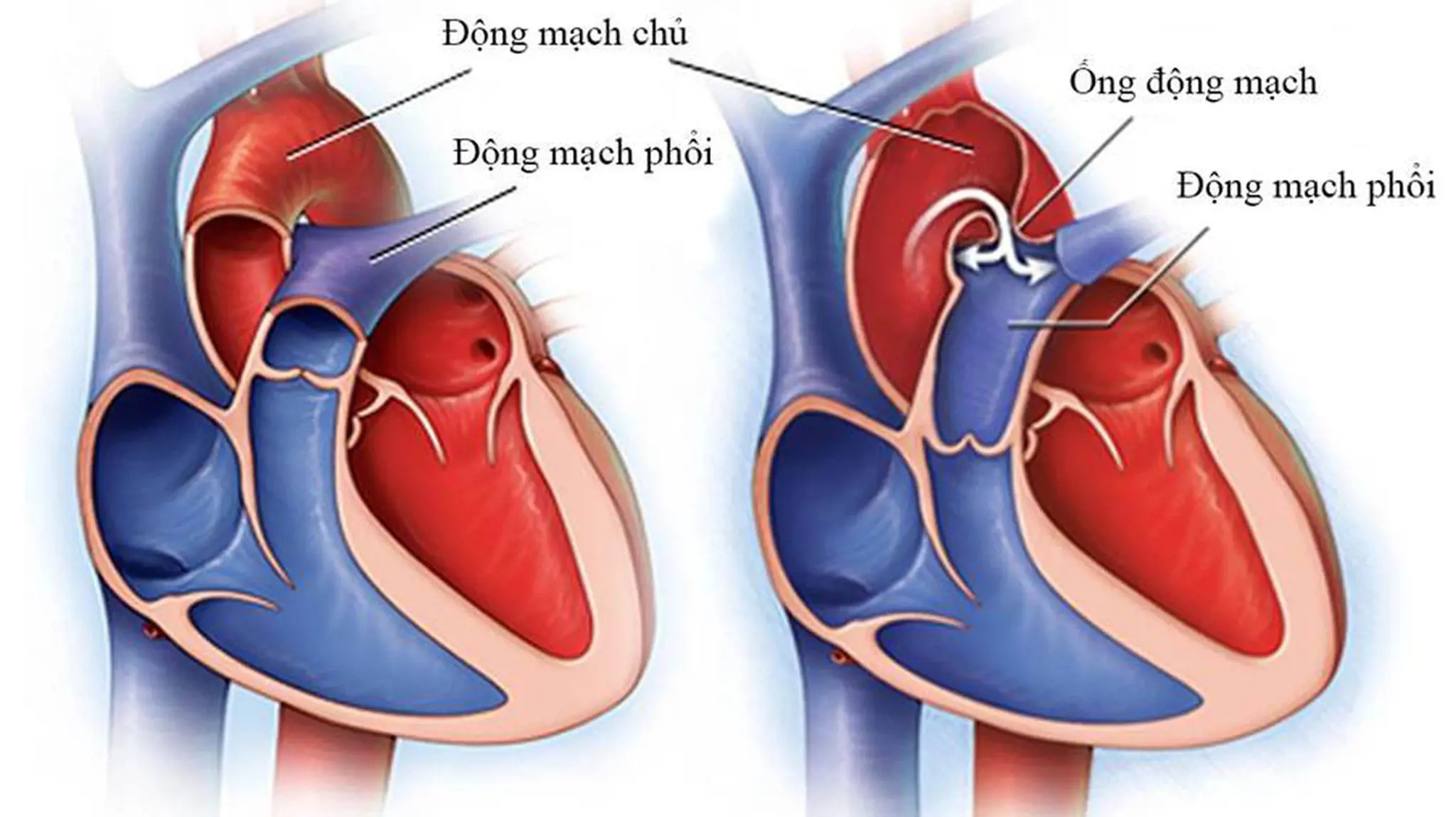 Còn ống động mạch: Nguyên nhân, triệu chứng, phương pháp điều trị