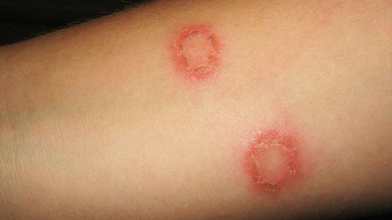 Tìm hiểu chung Lao da