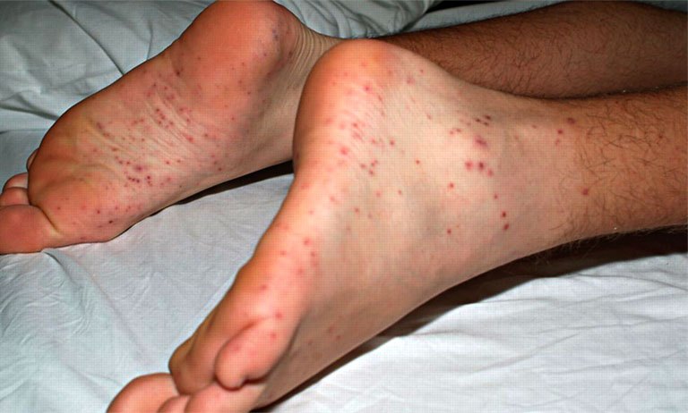 Bệnh Still ở người lớn là gì? Nguyên nhân, triệu chứng và cách điều trị hiệu quả