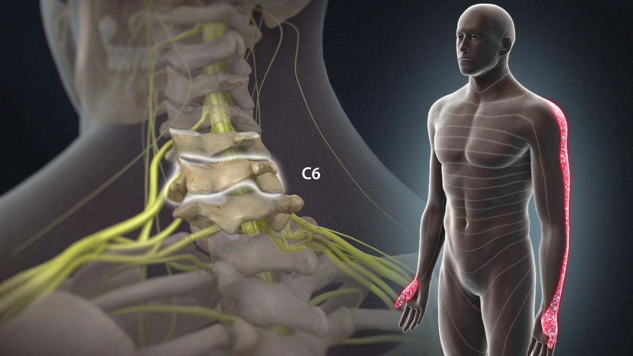 Những điều cần biết về bệnh rễ thần kinh