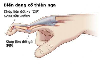 Tìm hiểu chung Biến dạng cổ thiên nga