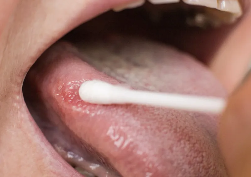 Bạch sản: Triệu chứng, nguyên nhân và cách điều trị