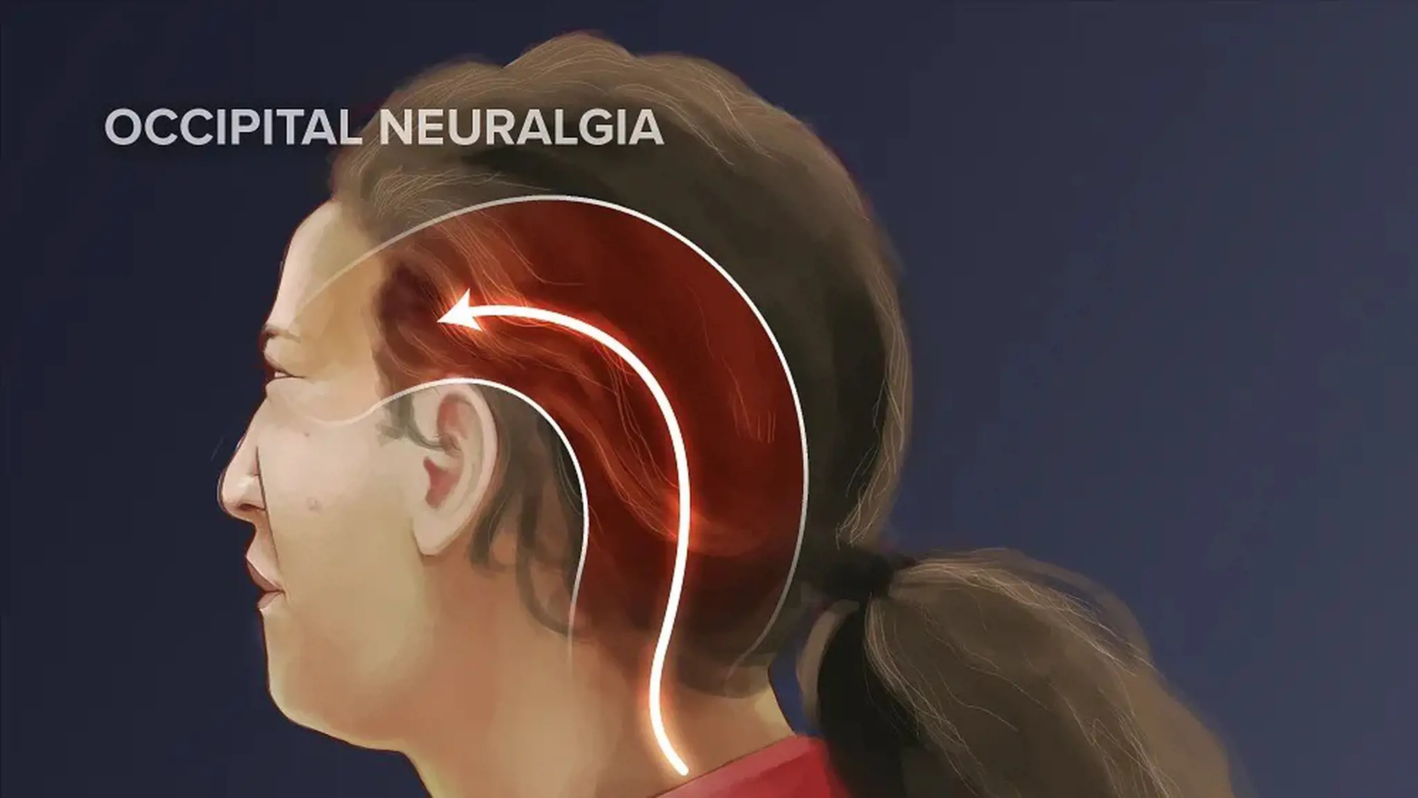 Đau đầu Arnold là gì? Triệu chứng và cách điều trị đau đầu Arnold