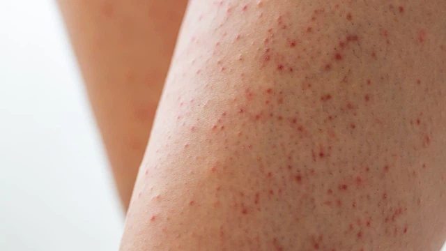 Tìm hiểu chung dày sừng nang lông