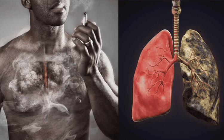 Nguyên nhân dẫn đến ung thư phổi ?