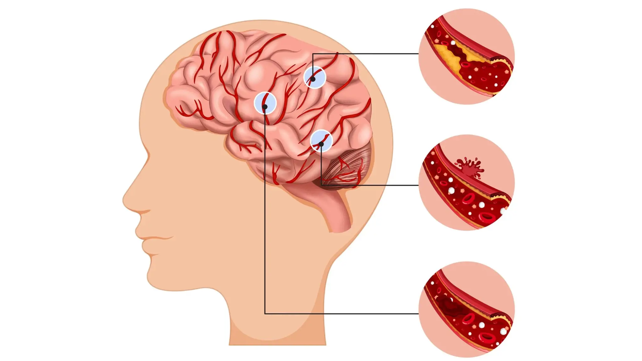 Đột quỵ não: Nguyên nhân, triệu chứng, phương pháp điều trị