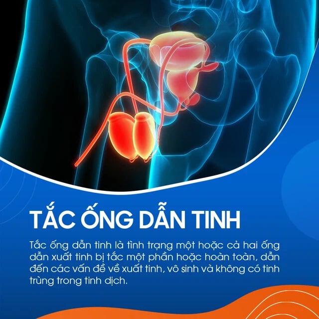 Tắc ống dẫn tinh là gì?