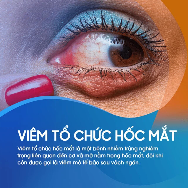 Viêm tổ chức hốc mắt là gì?
