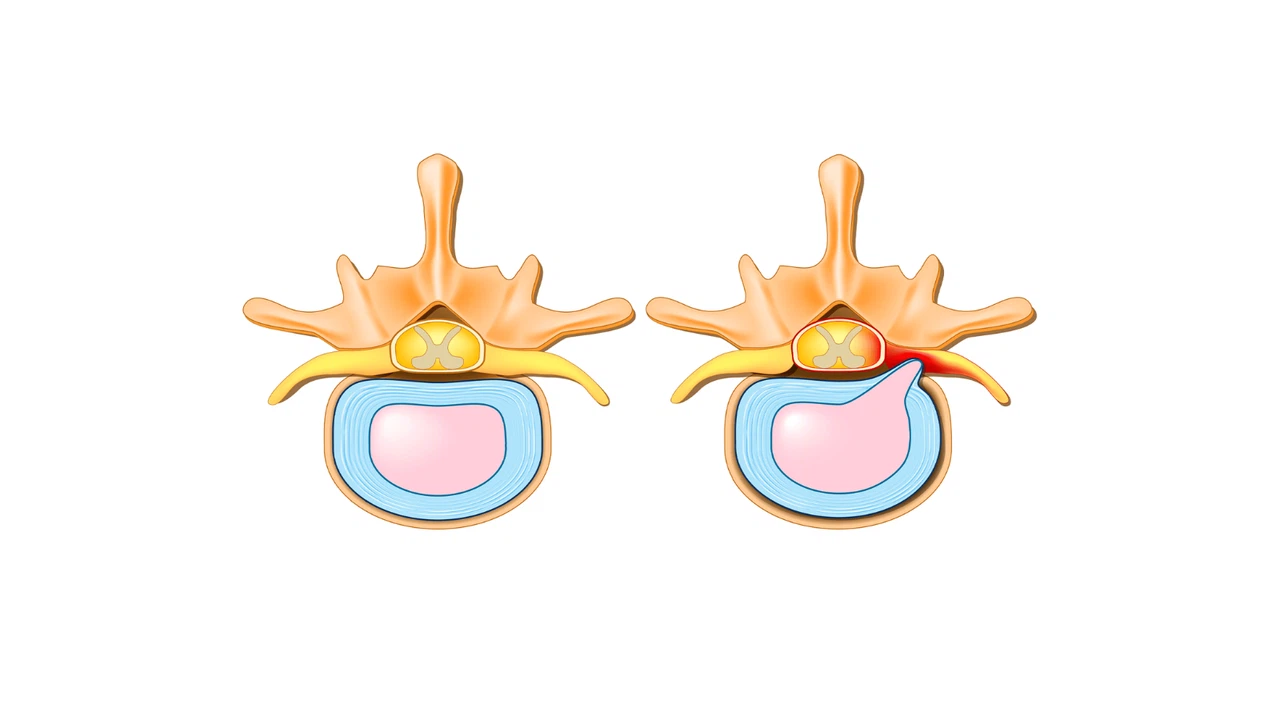 Hẹp lỗ liên hợp đốt sống cổ là gì? Nguyên nhân, triệu chứng và cách điều trị