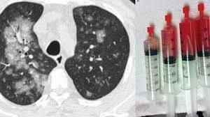 Xuất huyết phế nang lan tỏa là gì? Những vấn đề cần biết về bệnh xuất huyết phế nang lan tỏa