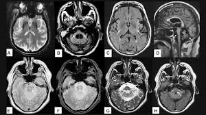 Bệnh teo đa hệ thống là gì? Nguyên nhân và cách điều trị bệnh teo đa hệ thống